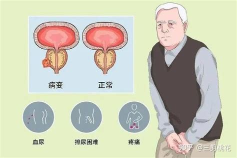 前列腺为有什么症状和危害 - 知乎