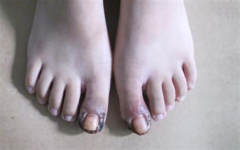 婴儿甲沟炎图片