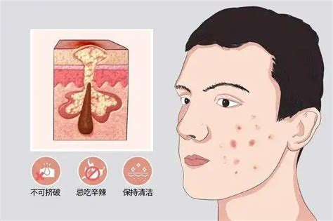 座疮图片