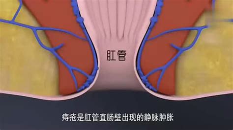 痔疮打针脱落图片