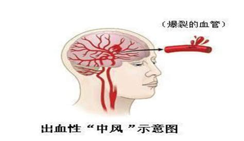 高血压脑出血的手术治疗 - 脑医汇 - 神外资讯 - 神介资讯