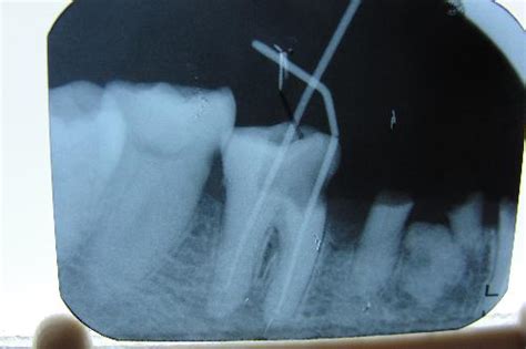 深圳爱康健口腔：牙齿做根管治疗的步骤和费用_深圳爱康健口腔医院官网