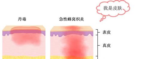 蜂窝织炎图片