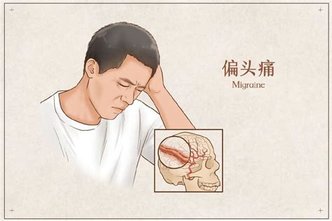 还在头痛医头? 如果你经常偏头疼, 最好去检查这三个地方!