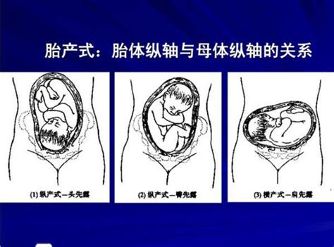 胎位图图片
