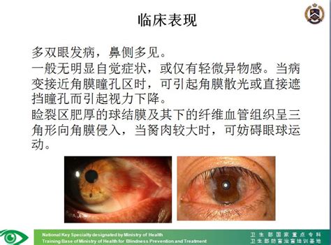 胬肉图片