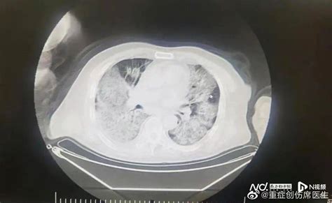 感染新冠会变“白肺”吗？医生：少量患者肺被感染有渗液 有年轻人病例_腾讯视频
