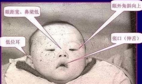 为何“唐氏宝宝”普遍长得很“相似”？背后的真实原因令父母落泪-搜狐大视野-搜狐新闻