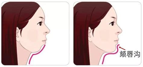 弄清楚颏成型和正颌区别，才知道下颌后缩做正颌还是颏成型?整形案例 - 北京圣嘉新医疗美容医院 - 炫美网