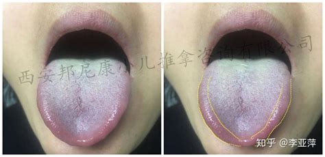 舌象分析图片