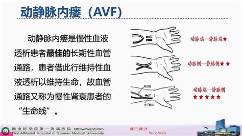 动静脉内瘘图片