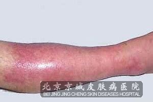 丹毒早期症状图片