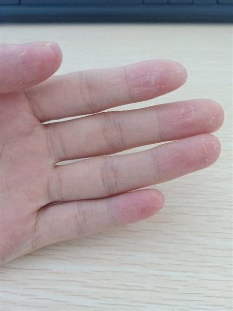 手指上长了很多不痛不痒的小疙瘩，像小水泡但是干的，这是怎么回事呢？ - 知乎