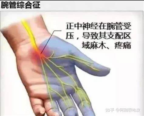 健身导致手腕疼痛的原因及治疗(健身手腕疼怎么快速缓解)