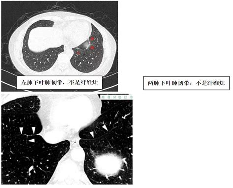 放射科报告解读一——肺部条索影-健康科普-武汉市第三医院|武汉大学同仁医院