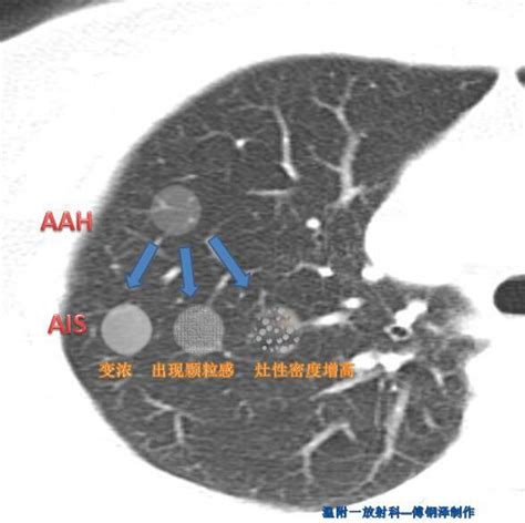 肺磨玻璃结节之2---AAH到AIS的演变 - 微医（挂号网）