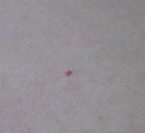 皮肤上出现了血红色的红点，还有几乎透明的血红色的红疙瘩