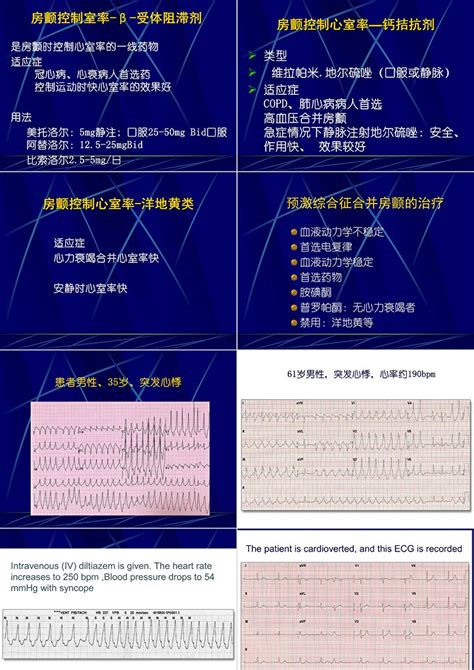 心电图图例分析：心房颤动、完全性右束支合并左前分支阻滞，左心室肥大-专业文章