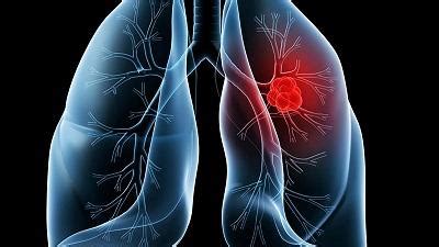 肺癌的15个征兆,正常肺和肺图片,肺症状_大山谷图库