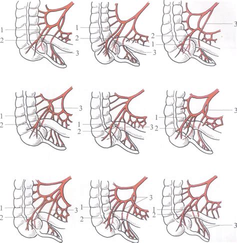 图13-8 盲肠动脉和阑尾动脉的变异-外科学-医学