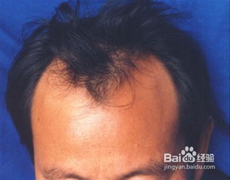 如何区分休止期脱发和雄激素性秃发？ - 知乎