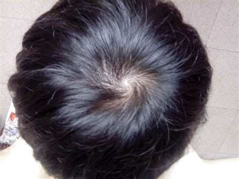 4大常见头发问题及其应对方法，你都做对了吗