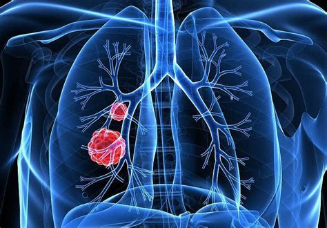 肺癌系列之Ⅳ期 NSCLC综合治疗 - 知乎