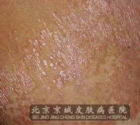 毛发红糠疹图片