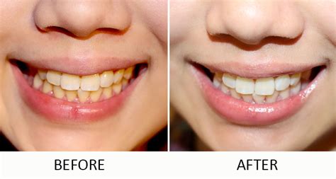 几种常见的牙齿美白方法，哪些安全可靠？|过氧化氢|牙釉质|漂白剂|牙齿|-健康界