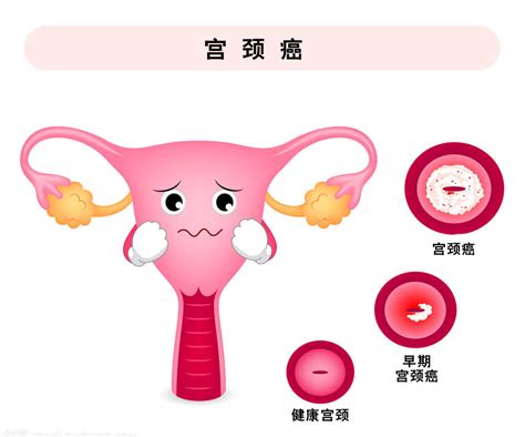 宫颈图片
