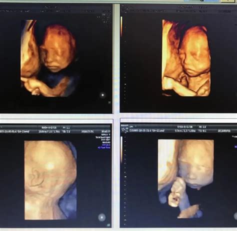双胎的胎儿系统超声（四维彩超），可不是简单的“1+1”！-嘉兴悦程妇产医院-提供产检/分娩/月子/产后一站式医疗服务