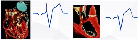 心电图图例分析：心房起搏心律AAI模式-专业文章