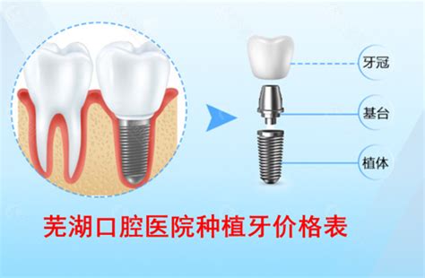 种植一颗牙齿价格是多少?北京、上海种植牙收费价格表更新 - 爱美容研社