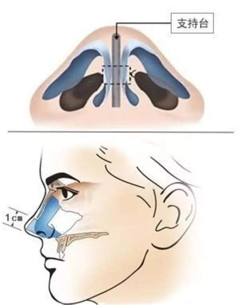 【图】玻尿酸隆鼻的后遗症和优势有哪些？ 和手术相比有很大优势_玻尿酸隆鼻_伊秀美容网|yxlady.com