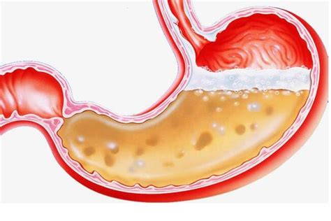 胃酸反流一定是胃酸过多吗？一起来了解我们的胃酸 - 知乎