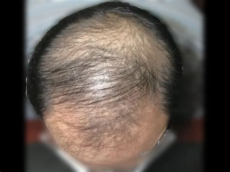 35岁男子被雄激素性脱发困扰多年，药物治疗长出头发！-有来医生