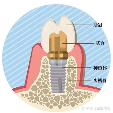 get湖南省种植牙较好的医院,常有种牙活动的牙科及价格分享,种植牙-8682赴韩整形网