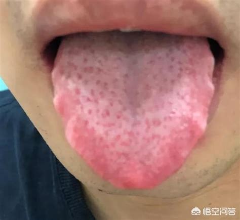 芒刺舌图片
