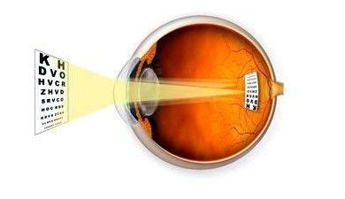 大连康桥眼科视光诊所有限公司-高度近视散光的矫治