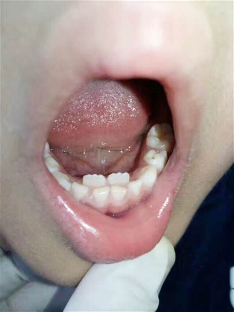 牙龈侧面长牙齿图片图片