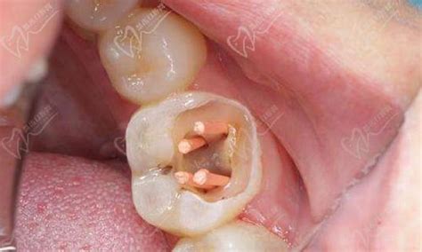 牙髓息肉怎么处理图片，教你牙髓息肉和牙龈息肉的判断方法_皓齿口腔网