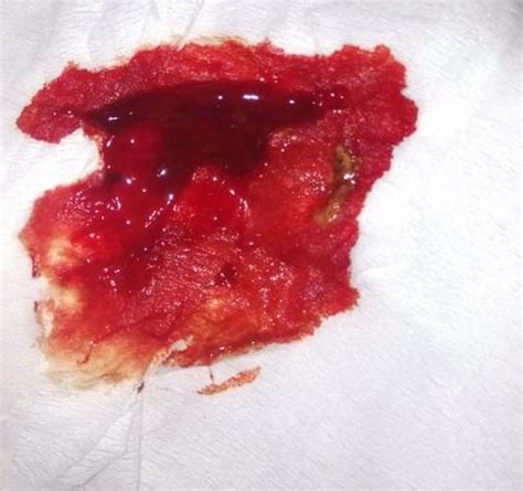 暗红色的血肠癌图片
