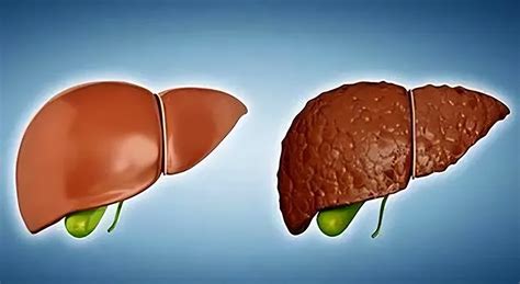 肝脏不好有什么表现症状有哪些-肝脏不好吃什么-怎么保护肝脏