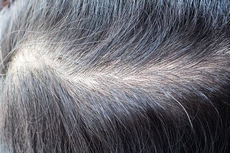 秃头治疗头发移植手术室的外科医生进行毛发移植手术从头部的一部分移动毛高清图片下载-正版图片504090304-摄图网