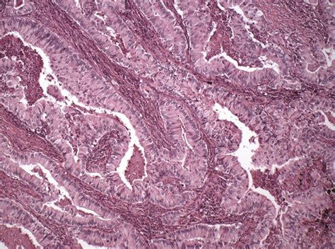 如何治疗驱动基因阴性晚期非小细胞肺癌患者？ - 知乎
