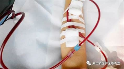 血液净化9种模式已广泛应用_患者
