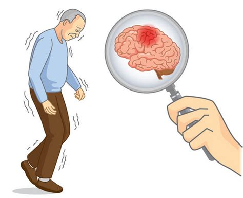Brain：Wilson病脑损伤的神经影像特征—一项多模态全脑MRI研究 - 知乎