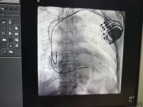 植入三腔起搏器 让衰竭的心脏强大起来 --- 厦门大学附属中山医院