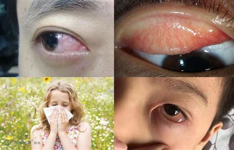 眼睛“痒死了”，怎么办？过敏性结膜炎如何治疗和预防_陶博士视光