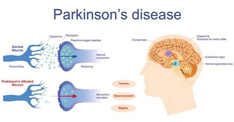 首个基因疗法治疗帕金森病，治疗一次，维持3年！|帕金森病|多巴胺|基因|-健康界